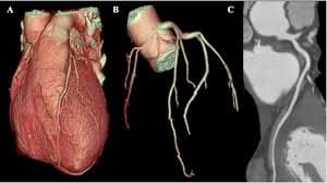 Coronary Angiogram 2
