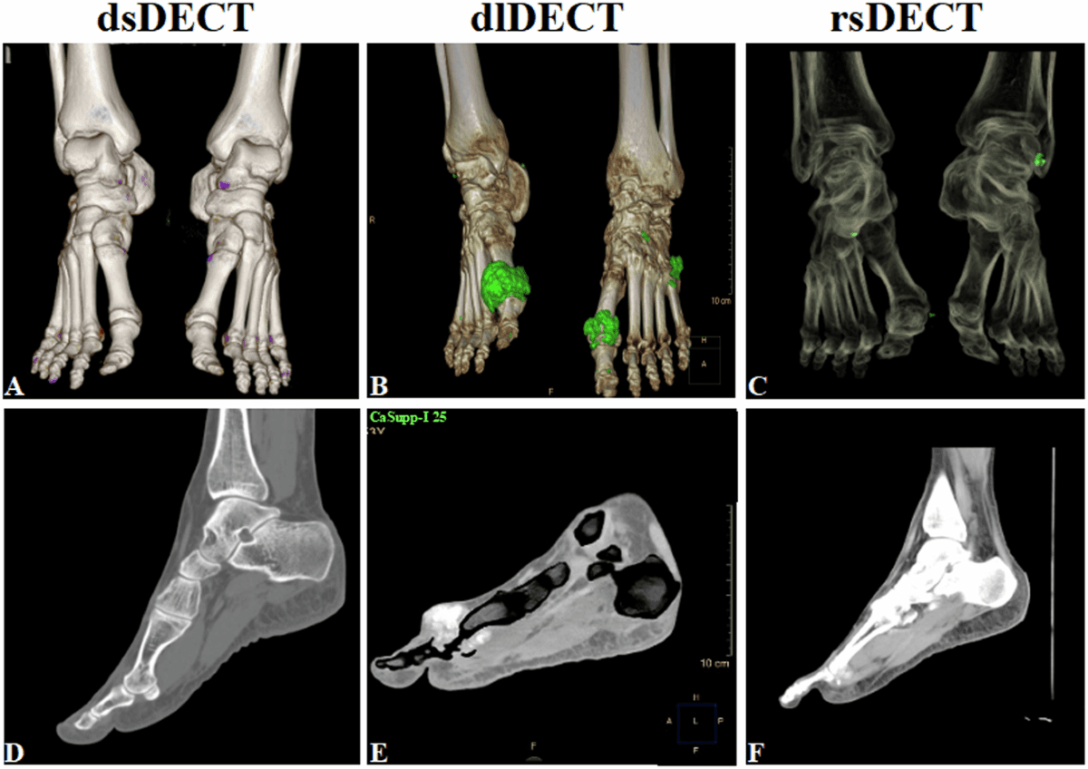 Gout Imaging
